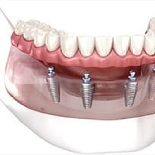 Are you struggling with your dentures?